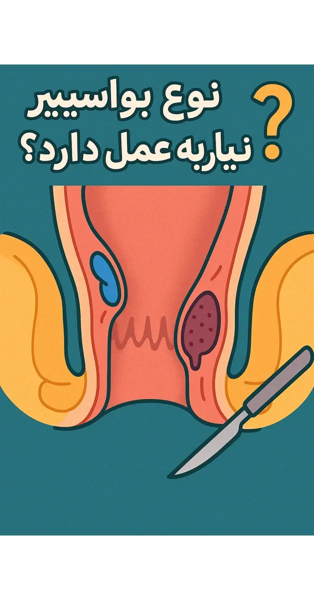 چه نوع بواسیر نیاز به عمل دارد