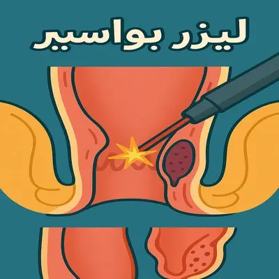تصویر شماتیک درمان بواسیر با لیزر در محیط کلینیکی مدرن