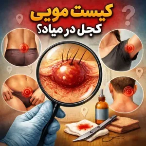 کیست مویی کجا در میاد