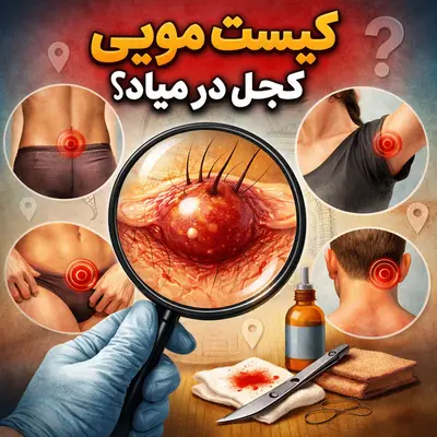 کیست مویی کجا در میاد