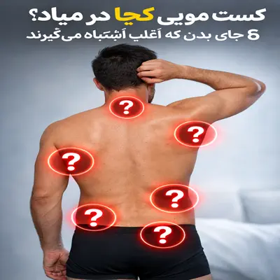 کیست مویی کجا در میاد؛ محل‌های شایع بروز در بدن