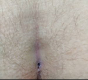 علائم کیست مویی مقعدی