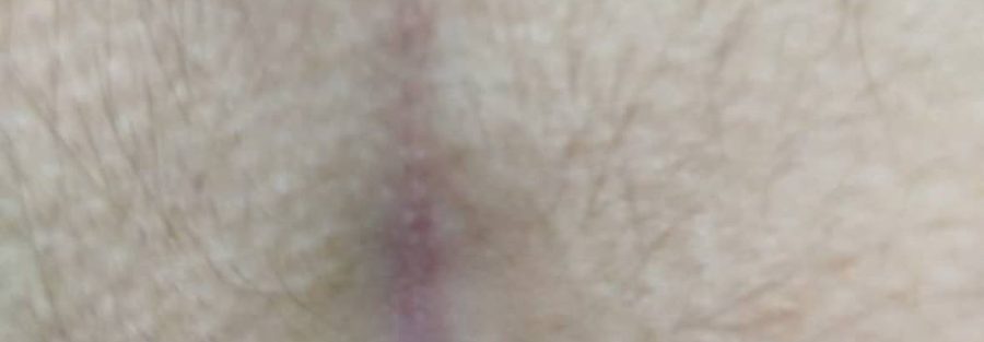 علائم کیست مویی مقعدی