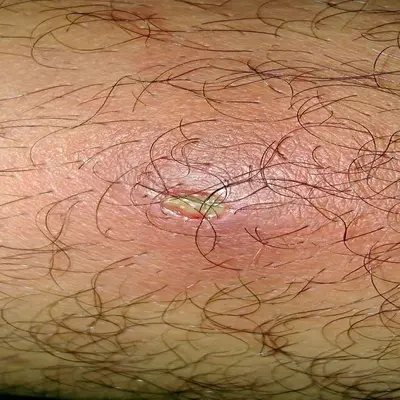 درمان خانگی کیست مویی