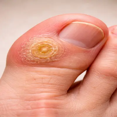 میخچه بزرگ روی انگشت پا