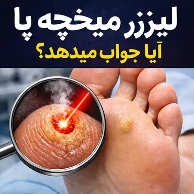 لیزر میخچه