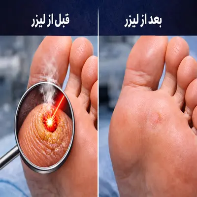 درمان میخچه با لیزر در تهران