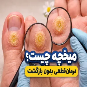 میخچه چیست؟