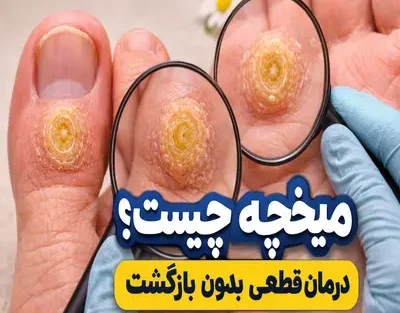 میخچه چیست؟