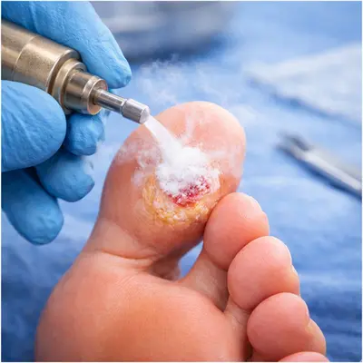 درمان میخچه پا با کرایوتراپی (فریز)