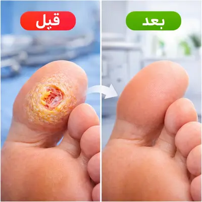 قبل و بعد جراحی میخچه پا