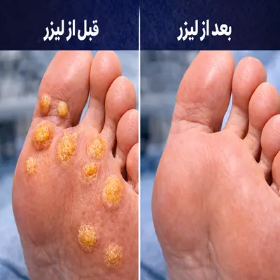 درمان میخچه پا با لیزر