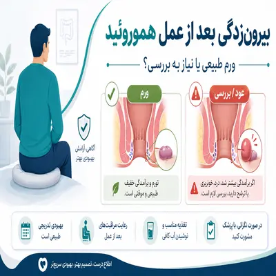 بیرونزدگی بعد از عمل هموروئید با عکس