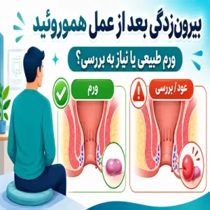بیرونزدگی بعد از عمل هموروئید