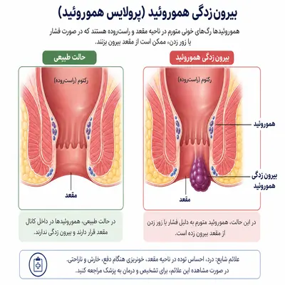 عکس ورم و بیرونزدگی بعد از عمل هموروئید