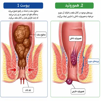 بیرونزدگی بعد از عمل هموروئید؛ ورم یا عود