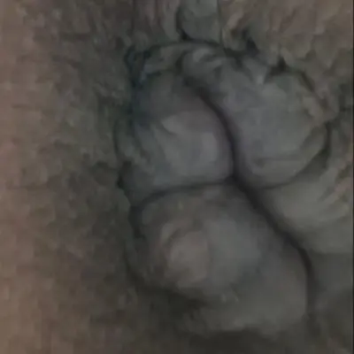 محل قرارگیری عضله اسفنکتر داخلی و خارجی مقعد و نقطه ایجاد شقاق